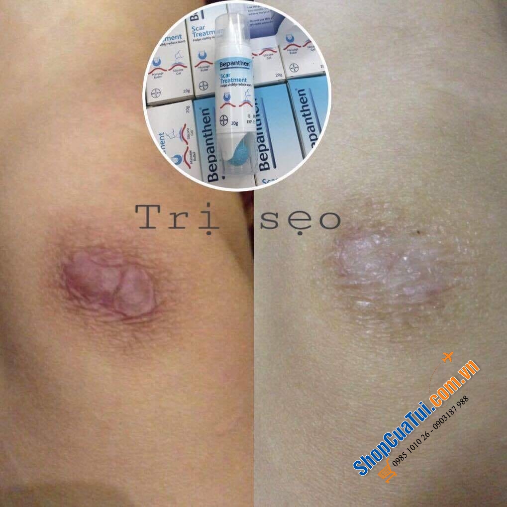 Kem trị sẹo CẤP TỐC Bepanthen Scar Treatment cho da mịn đẹp mờ sẹo