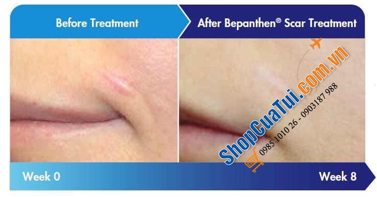 Kem trị sẹo CẤP TỐC Bepanthen Scar Treatment cho da mịn đẹp mờ sẹo