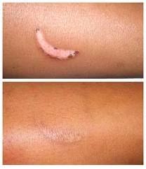 DERMATIX SCAR REDUCTION - Sản phẩm cao cấp hàng đầu trong điều trị sẹo lồi, sẹo phì đại 