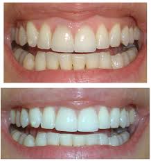 MIẾNG DÁN TẨY TRẮNG RĂNG ORAL B 3D (14 GÓI) – ORAL B 3D WHITE WHITESTRIPS