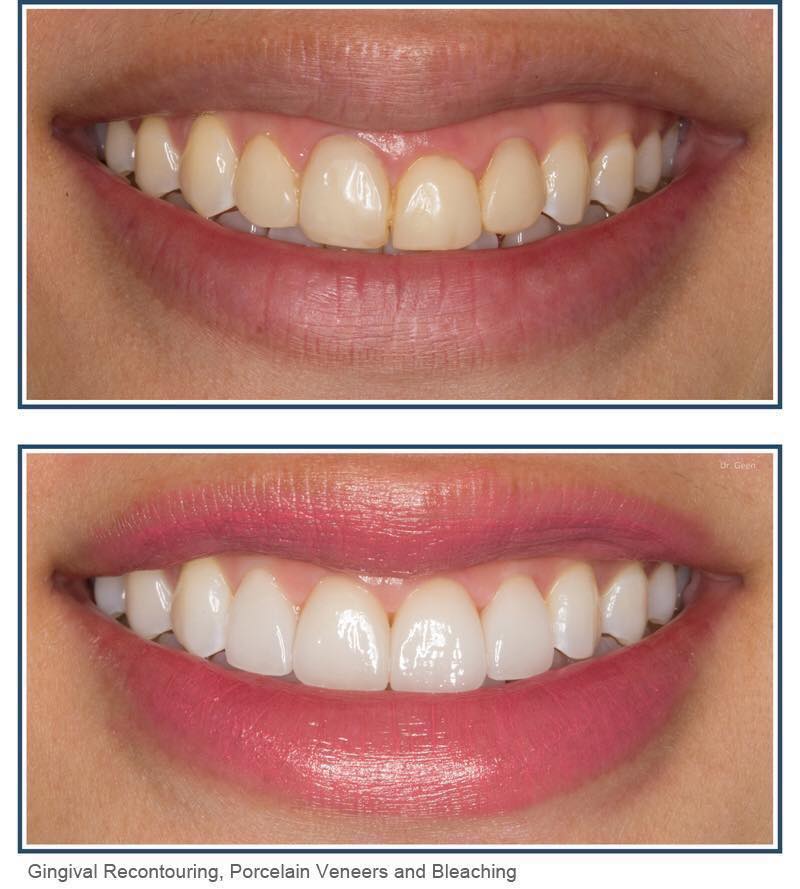MIẾNG DÁN TẨY TRẮNG RĂNG ORAL B 3D (14 GÓI) – ORAL B 3D WHITE WHITESTRIPS