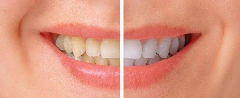 MIẾNG DÁN TẨY TRẮNG RĂNG ORAL B 3D (14 GÓI) – ORAL B 3D WHITE WHITESTRIPS