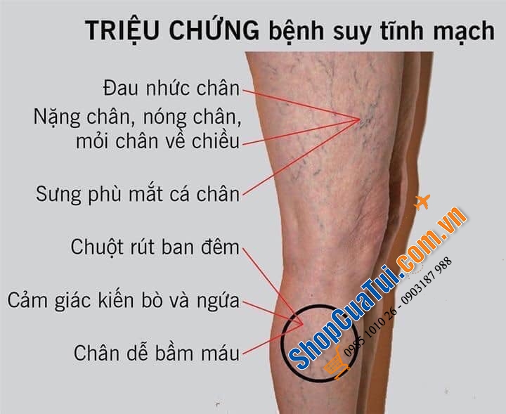 KEM BÔI CHỐNG GIÃN TĨNH MẠCH ABTEI