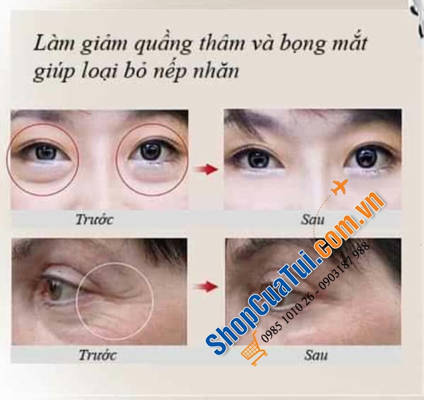 Bút trị mụn trứng cá, nâng cơ, giảm nhăn 2 in 1 Medisana DC300 (Model đời sau của DC200 giảm nhăn mắt đã đc chị e rất yêu thích).