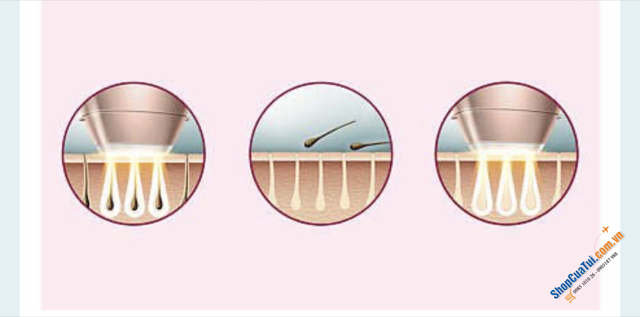 MÁY TRIỆT LÔNG Philips Lumea Advanced IPL BRI920/00 - Chuyên gia công nghệ IPL tại nhà, được phát triển với các bác sĩ da liễu