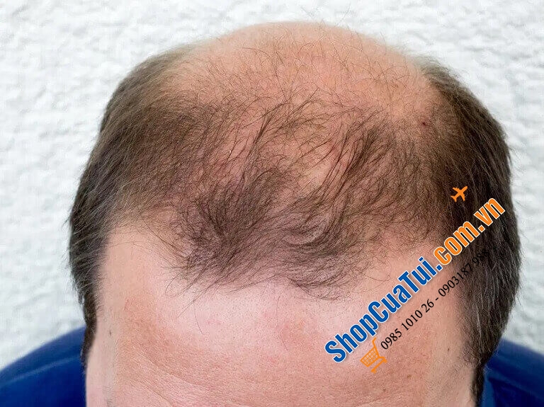 Dầu gội đầu trị rụng tóc, hói đầu làm dầy và dài tóc Priorin của ĐỨC.