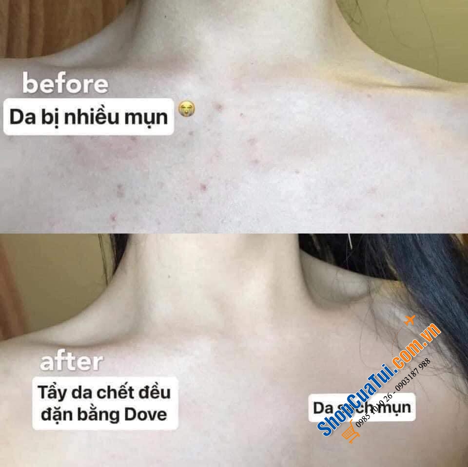 Tẩy da chết Body DOVE ĐỨC 225ml - giúp làn da sáng, mịn màng mềm mại, dưỡng ẩm tự nhiên nhưng không gây nhờn, cho một làn da mượt mà…