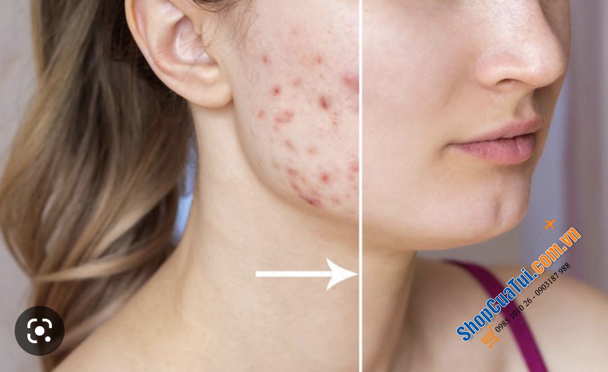 Kem bôi trị mụn trứng cá floresan - Dành cho chăm sóc da dễ bị mụn trứng cá.