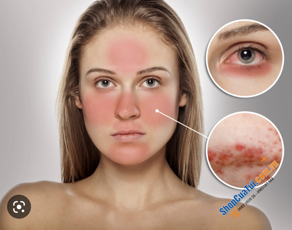Kem bôi trị mụn trứng cá floresan - Dành cho chăm sóc da dễ bị mụn trứng cá.